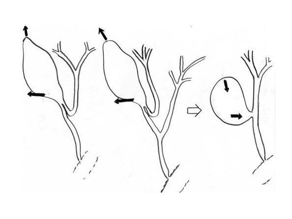 Figur 1: Eksempler på farlig anatomi: Kort ductus cysticus, og kort ductus cysticus med avgang fra høyre ductus hepaticus. Slik anatomi kan også gi telting av gallegang, som ytterligere kan disponere for gallegangsskade. 